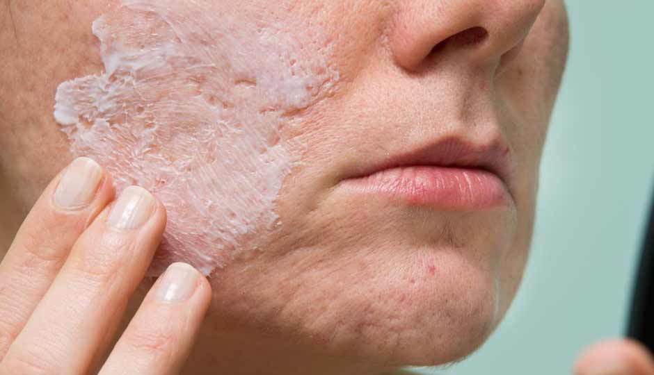 15 Detailed Benefits of Benzoyl Peroxide for Skin