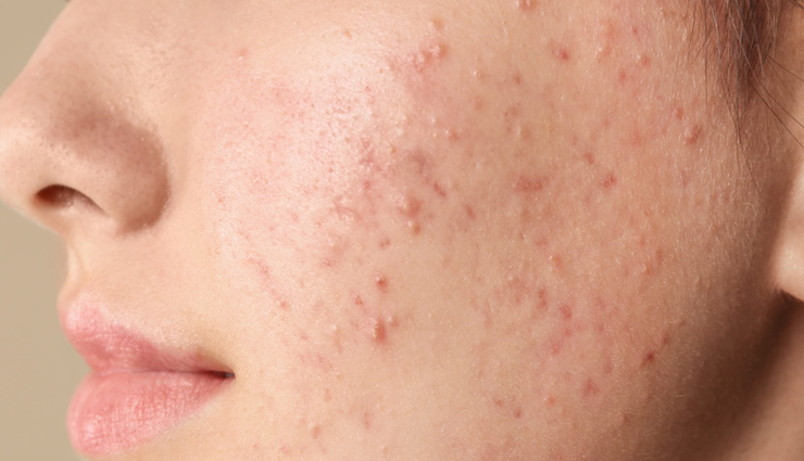 bergamot oil,bergamot oil for skin,beauty benefits of bergamot oil,skin care tips,beauty tips