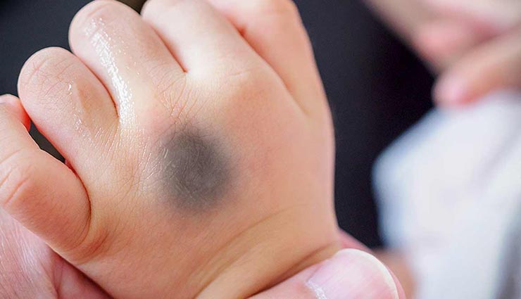 astrology tips,astrology tips in hindi,birthmark,birthmark affects