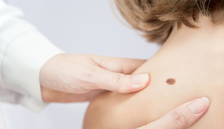 Natural Ways To Remove Birthmarks