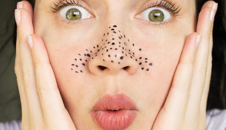 Easy and Home Remedies to Remove Blackheads