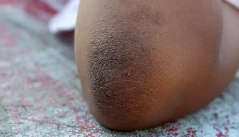 कोहनियों का कालापन कैसे करें दूर? अपनाएं ये आसान घरेलू उपाय, त्वचा दिखेगी साफ और निखरी कोहनियों का कालापन कैसे करें दूर? अपनाएं ये आसान घरेलू उपाय, त्वचा दिखेगी साफ और निखरी