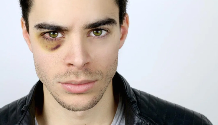 5 Home Remedies To Help You Get Rid of Black Eye