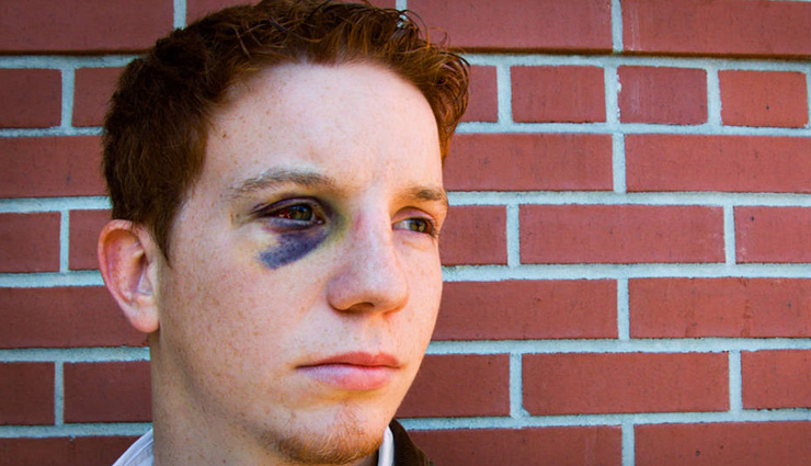 home remedies,home remedies to treat black eye,eye care tips,Health tips,fitness tips