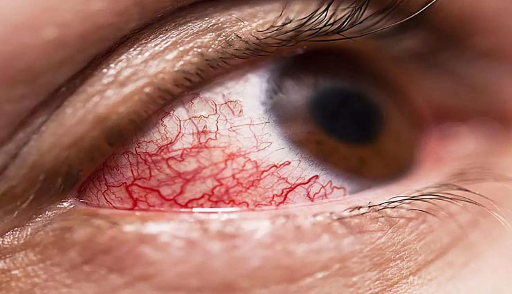 मेरठ में ब्लैक फंगस से हालत हो रहे खराब, मिले 24 नए मरीज, गई एक की जान