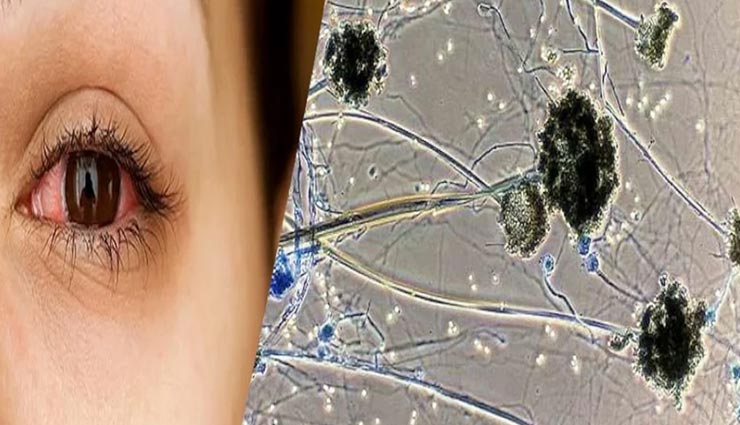 जयपुर : ब्लैक फंगस की जांचों में मच रही लूट, SMS में 5500 तो निजी लैब ले रही 28000 रुपए