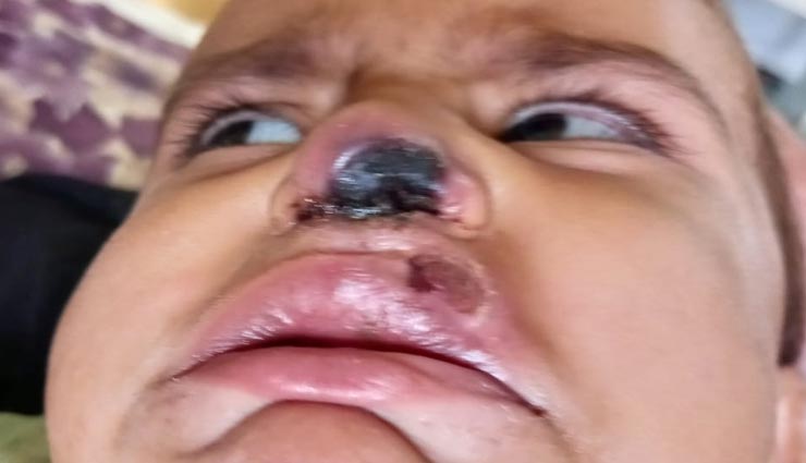 बीकानेर : डेढ़ साल के बच्चे को हुआ ब्लैक फंगस, नाक के नीचे कालापन देख डॉक्टरों ने करवाई जांच 