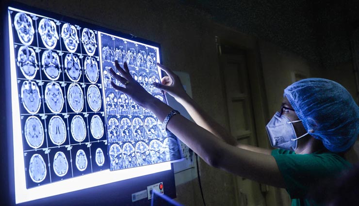 आगरा में जारी ब्लैक फंगस का कहर, दूसरी बार चपेट में आए मरीजों में नहीं दिखा कोई लक्षण