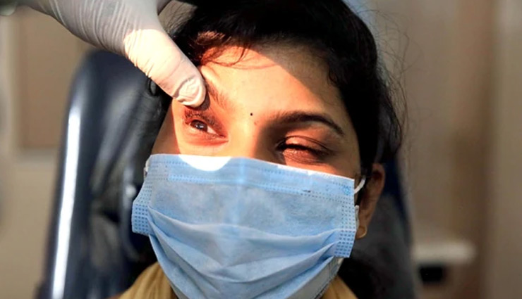 कोरोना के बाद इंदौर में ब्लैक फंगस का कहर जारी, 20 दिन में 32 मरीजों ने तोड़ा दम