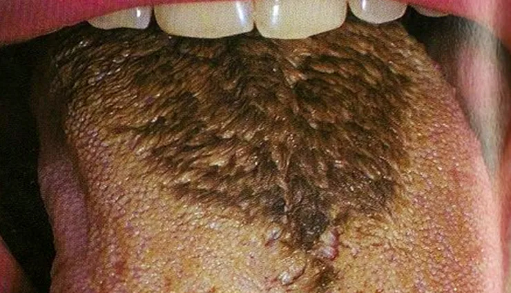 common mouth problems,tongue issues,dental hygiene,oral health concerns,mouth and tongue conditions,dental caries prevention,periodontal disease prevention,amalgam tattoo,halitosis treatment,black hairy tongue causes,canker sore remedies,tooth decay prevention,tooth abscess treatment,cold sore management,chipped tooth repair,leukoplakia diagnosis,lichen planus symptoms,thrush treatment,oral cancer detection,dry mouth remedies