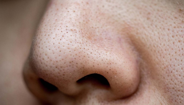 Remove Blackheads Overnight with These 8 DIY Remedies