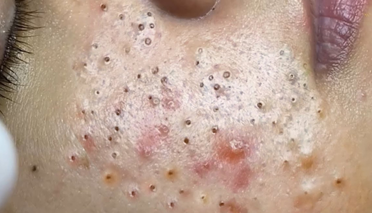 5 Quick Remedies To Say Goodbye To Blackheads