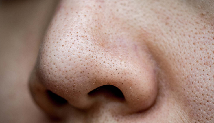 8 Self-Care and Preventive Tips for Blackheads