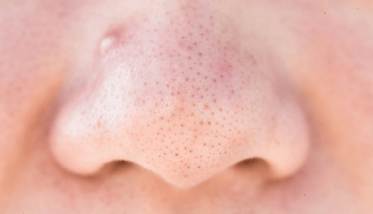 6 DIY Ways To Soften Blackheads Before Removal