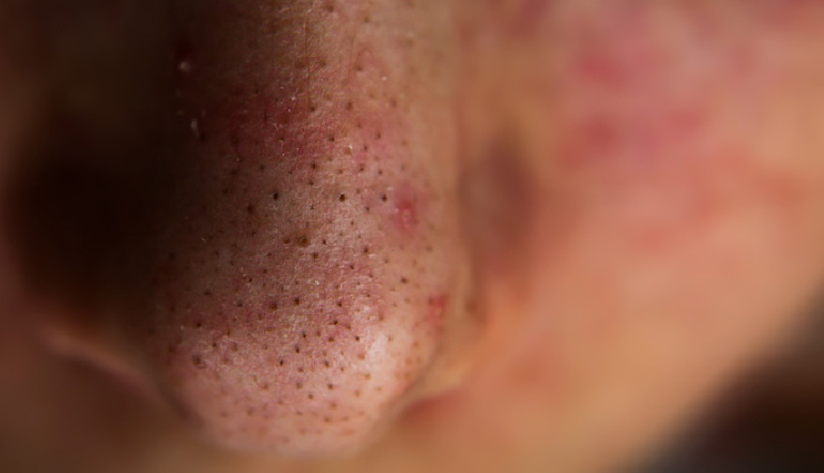 6 DIY Ways To Get Rid of Blackhead on Nose