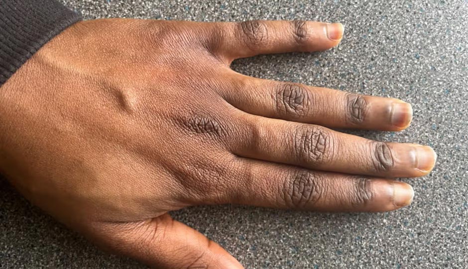 8 DIY Ways To Treat Black Knuckles