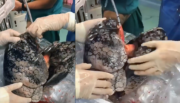 सिगरेट पिने की वजह से फेफड़े हुए काले, देख डॉक्टरों के भी उड़े होश