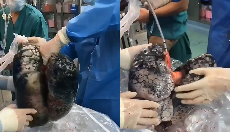 weird news in hindi,shocking video,black lungs,chain smoker,china,52 year old man,doctor