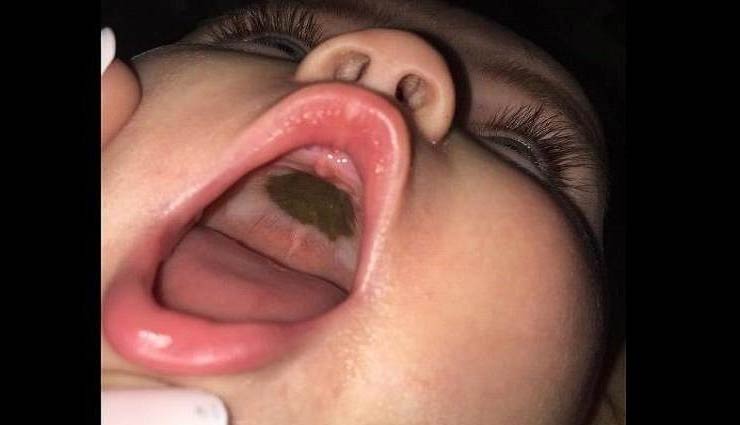 बच्ची के मुंह में काला निशान देख घबराई मां, वजह पता चली तो फूट पड़ी हंसी