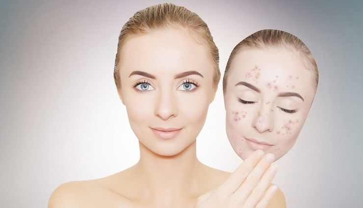 5 Home Remedies To Get Rid of Black Spots From Face