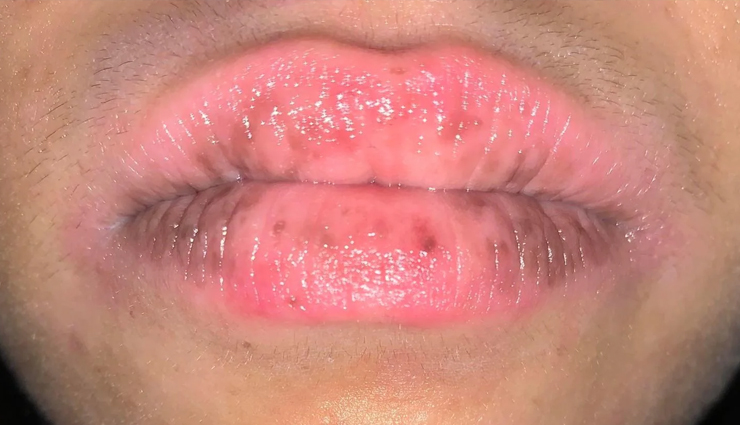 10 Best Home Remedies To Cure Black Spots On The Lips