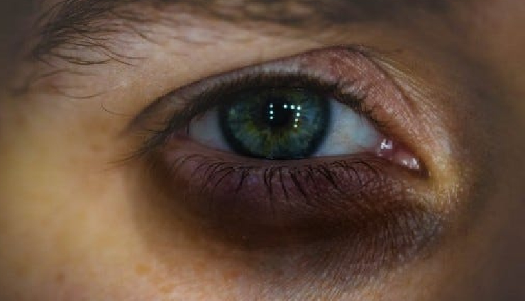 10 Effective Home Remedies To Treat Dark Under Eyes