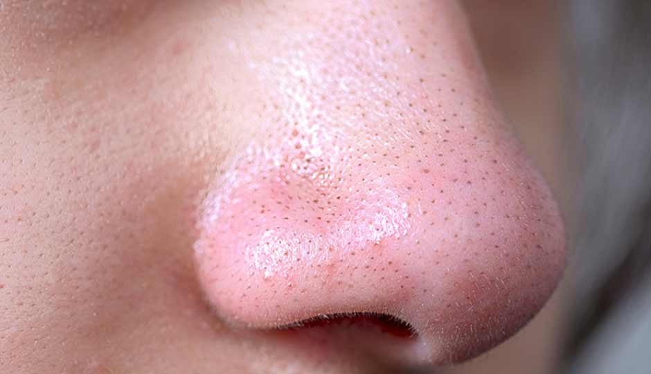 12 Effective Home Remedies to Treat Blackheads on the Nose Naturally