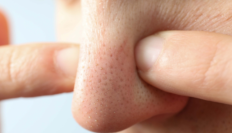 6 Home Remedies To Get Rid of Blackheads and Whiteheads