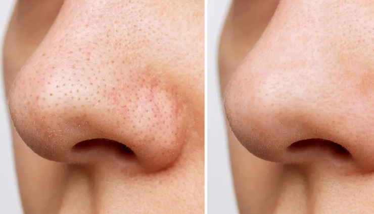 5 DIY Ways To Use Baking Soda To Get Rid of Blackheads