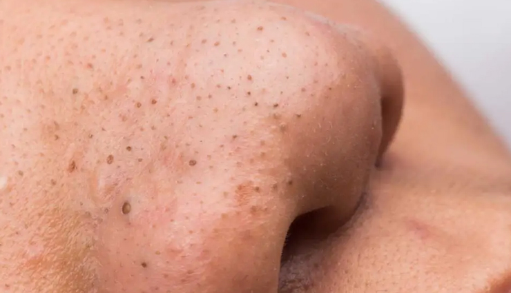 fungal acne explanation,understanding fungal acne,causes of fungal acne,symptoms of fungal acne,fungal acne treatments,fungal acne overview,fungal acne causes and remedies,how to treat fungal acne,fungal acne skin issues,fungal acne management