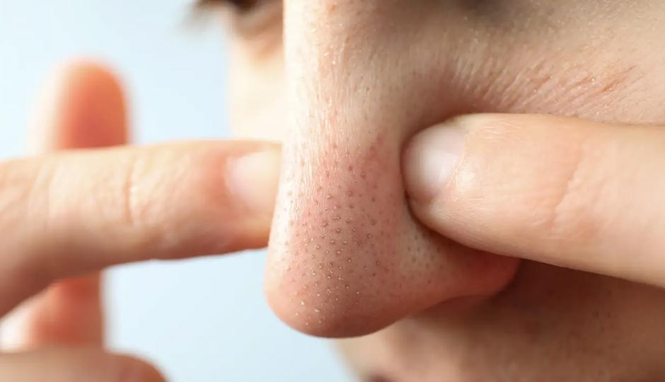 8 Must Try Home Remedies To Treat Blackheads