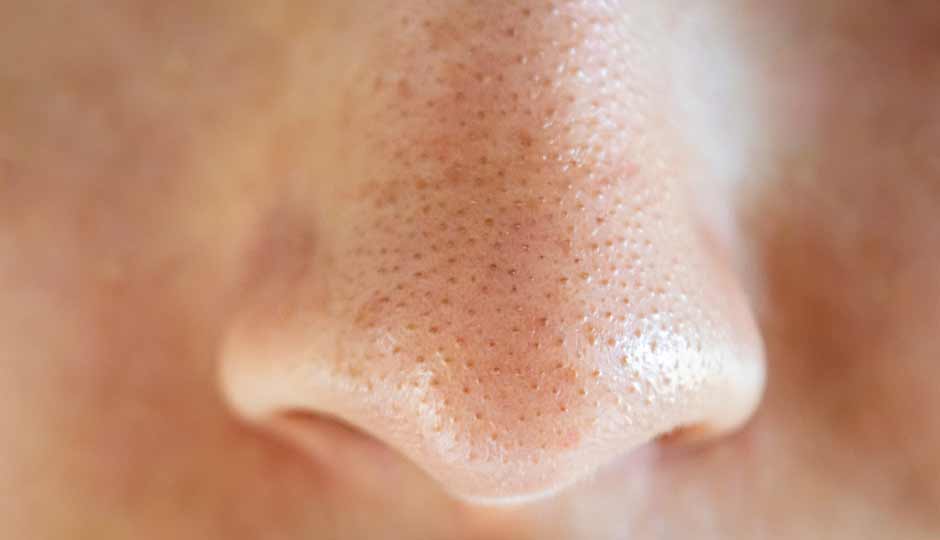 12 Effective Home Remedies to Treat Blackheads Naturally