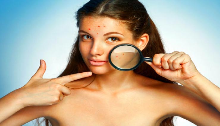 चेहरे की ख़ूबसूरती को घटाते हैं ब्लैकहेड्स, इनसे निजात पाने के लिए करें ये 5 उपाय