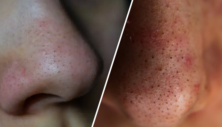 7 Must Try Home Remedies To Get Rid of Blackheads on Nose
