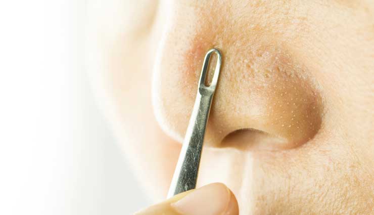 hydrogen peroxide,ways to use hydrogen peroxide for blackheads,tips to get rid of blackheads,skin care tips,beauty tips