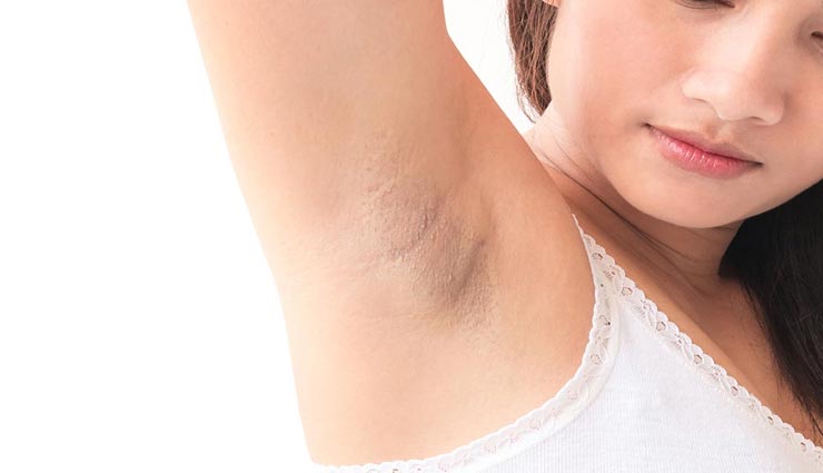 ये 3 घरेलू नुस्खे दिलाएँगे अंडरआर्म्स के कालेपन से निजात, जल्द ही दिखने लगेगा असर