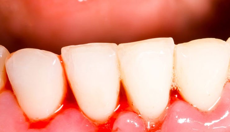 इन घरेलू नुस्खो की मदद से दूर करे दांतों और मसुडो की परेशानी 