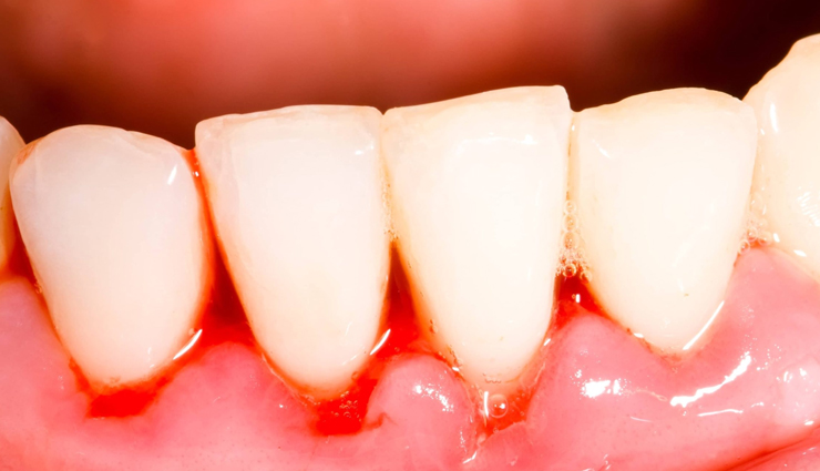 मुँह से निकलती दुर्गंध से खत्म होती है सामाजिकता, जानिये इसके कारण और निदान reasons for bad breath,home remedies for bad breath,how to get rid of bad breath naturally,causes and cures for halitosis,bad breath remedies at home,natural ways to freshen breath,home treatments for halitosis,tips to cure bad breath naturally,home remedies for chronic bad breath,halitosis causes and home solutions