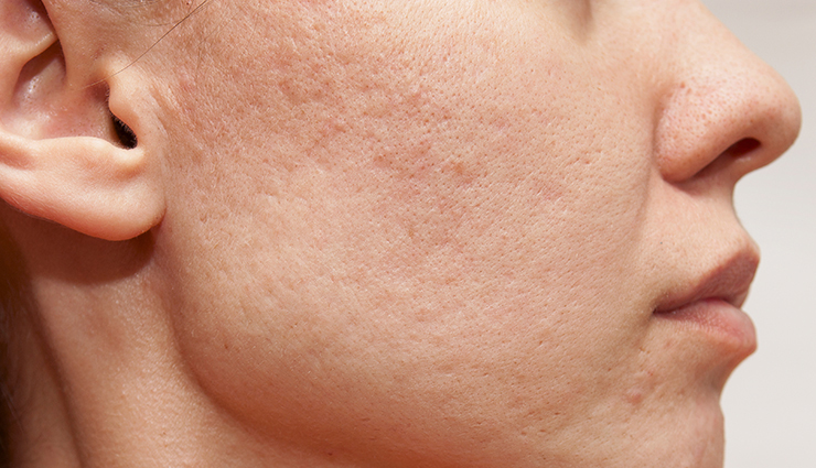 beauty benefits of tomato,face packs made of tomato,benefits of tomato,benefits of tomato,beauty tips,skin care tips,simple beauty tips