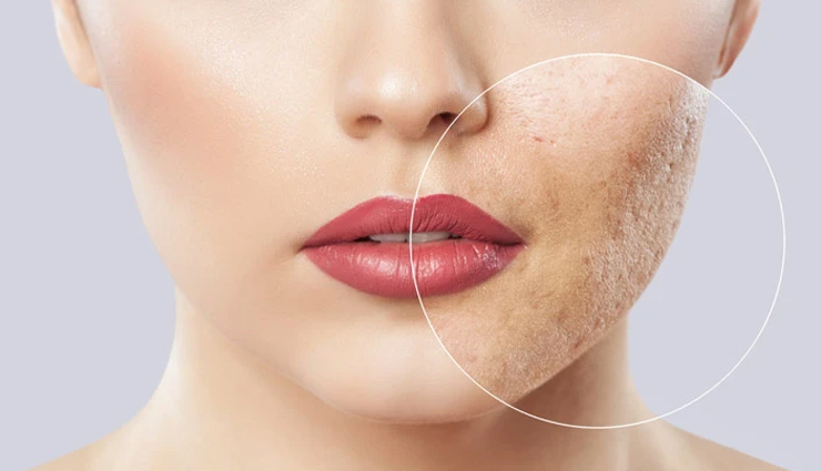 Get Rid Of Blemishes With These 6 Home Remedies