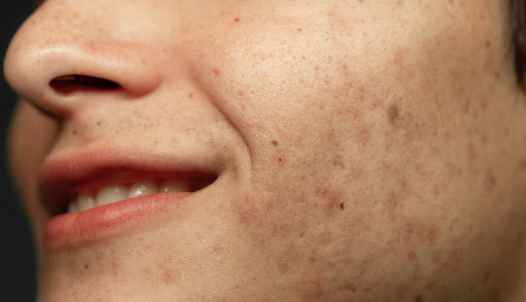 Effective Home Remedies To Get Rid Of Blemishes