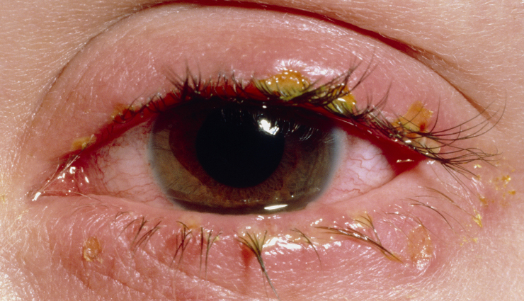 eye problems,eyes care,eye problem,blurred vision,lazy eye,diabetic retinopathy,cataract,glaucoma,blepharitis,crossed eyes,Health