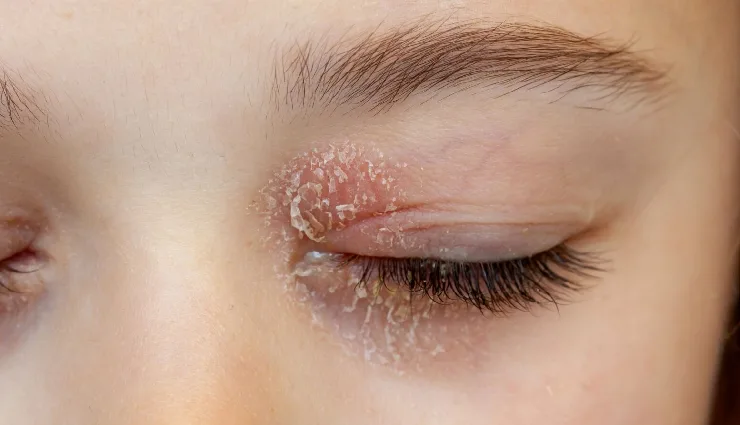 swollen eyelids,causes of eyelid swelling,puffy eyelids,eye inflammation,orbital cellulitis,graves’ disease,ocular herpes,eye allergy symptoms,swollen eye treatment,upper eyelid swelling,home remedies for swollen eyelids,red and swollen eyelid