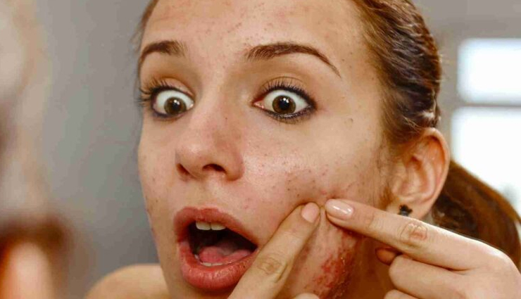 blind pimple under the skin remedies,how to treat a concealed pimple,getting rid of under-the-skin pimples,skin blemish prevention tips,home remedies for blind pimples,concealed pimple treatment,preventing hidden skin pimples,skin care for subcutaneous pimples,natural remedies for under-the-skin acne,pimple prevention and remedies