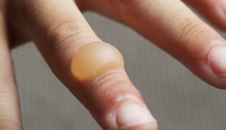 Get Rid of Painful Blisters With These Remedies