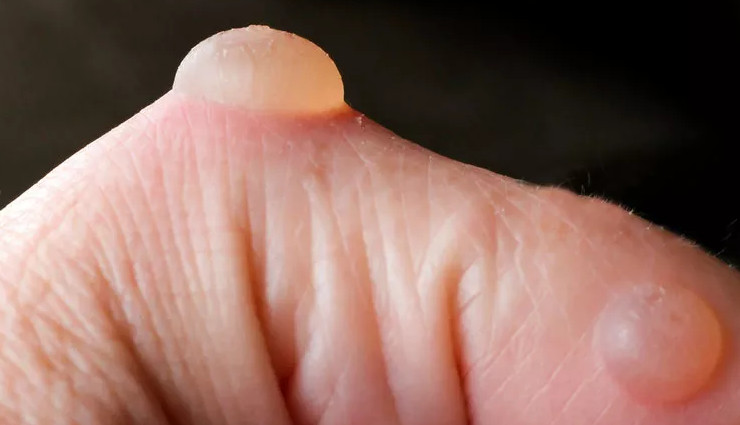 10 Home Remedies To Help You Get Rid of Blisters