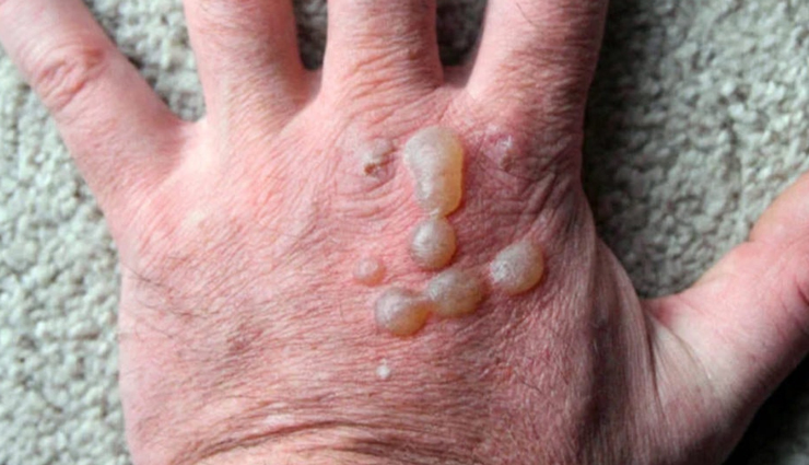 12 Remedies That Will Help You Treat Blisters