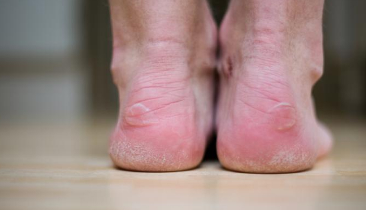 blisters,home remedies,home remedies for blisters,Health tips,fitness tips,summer tips