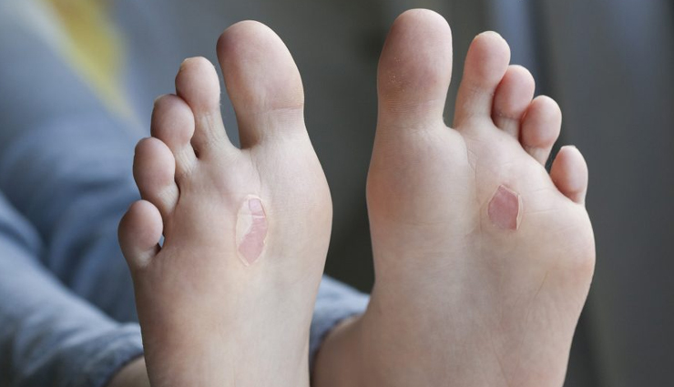 treating blisters,home remedies to treat blisters,healthy living,Health tips