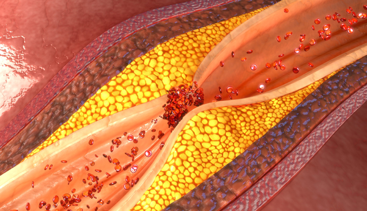 3 Remedies You Can Try for Blocked Arteries